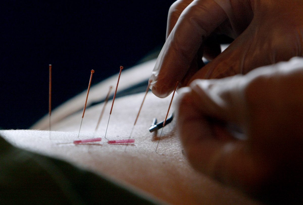 Now Acupuncture Proven a Powerful AntiInflammatory Ancient healing