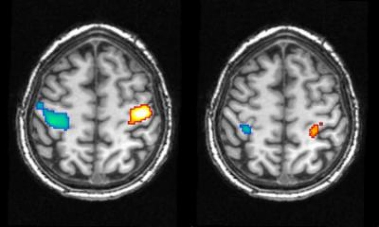 Brain activity during hand movement while awake (left) and during a dreamed movement (right). Blue areas show activity in a right hand movement (in the left brain hemisphere), while red regions show left-hand movements in the opposite brain hemisphere. (MIP of Psychiatry.)