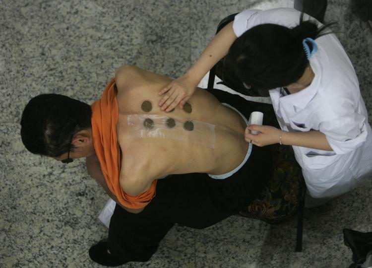 Application of Chinese herbal medicine to acupuncture points (China Photos/Getty Images)