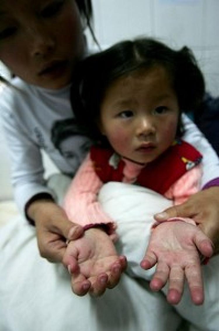 A young child's hands show a rash typical of Hand, Foot, and Mouth Disease. (AFP/Getty Images)