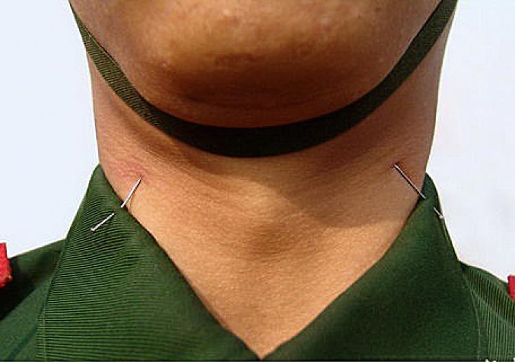 This young soldier has pins pricking him every time he fails to hold his head in the prescribed position. (Internet Photo)