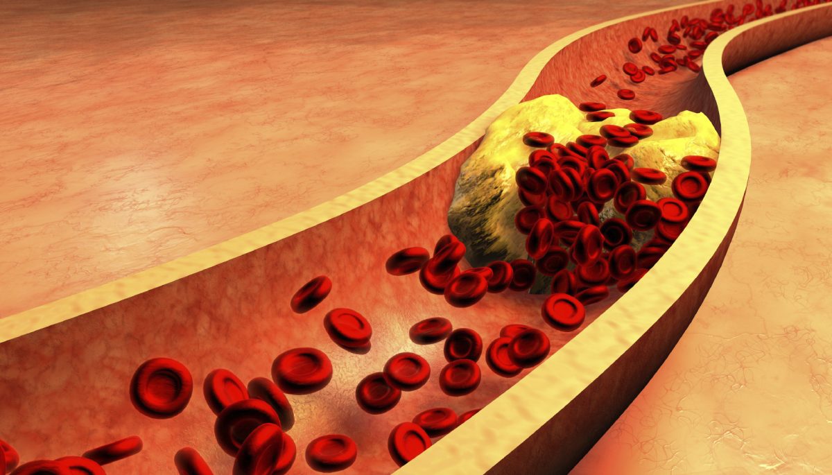 Plaques in Arteries Are Reversible The Epoch Times