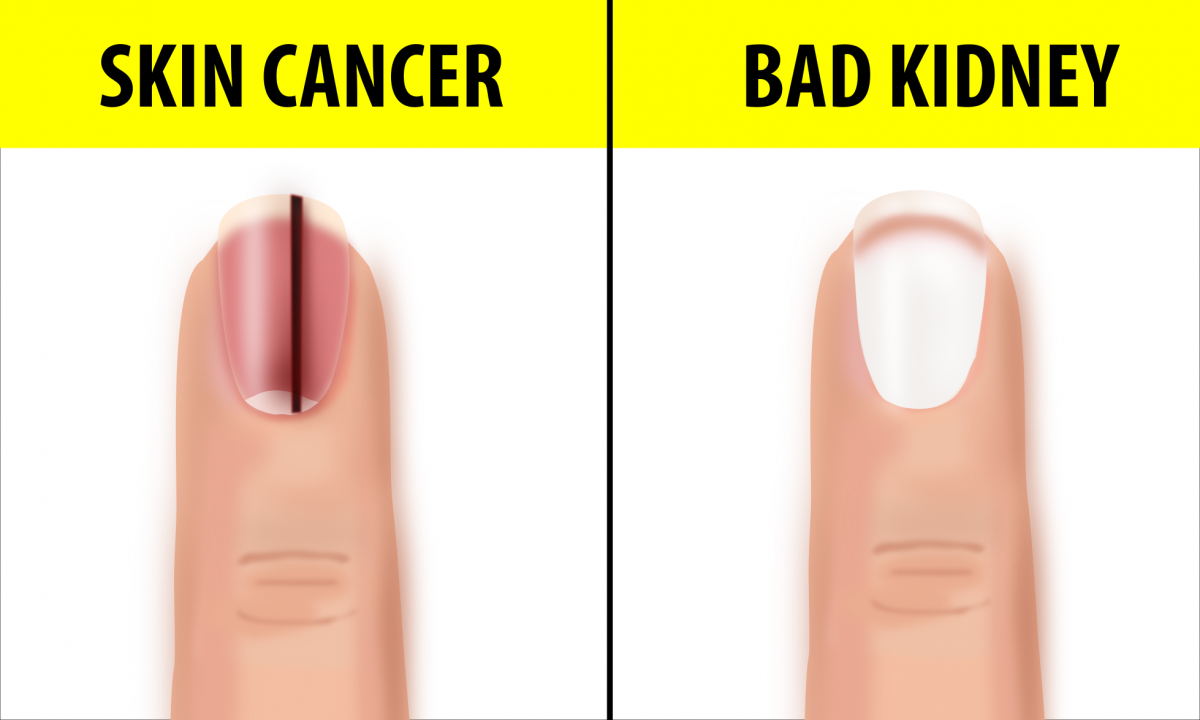 10 Fingernail Symptoms That Can Help Detect Health Conditions If You