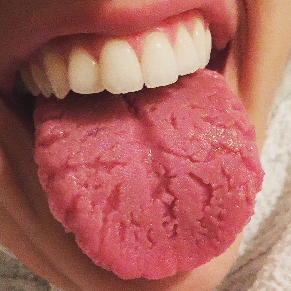 Fissured tongue