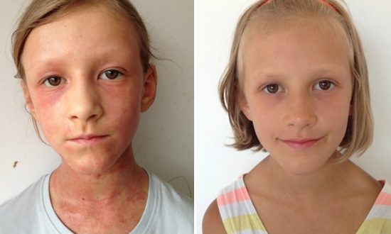 Mom Cures Daughter’s Severe Eczema With Fruit and Veg Miracle Raw Diet
