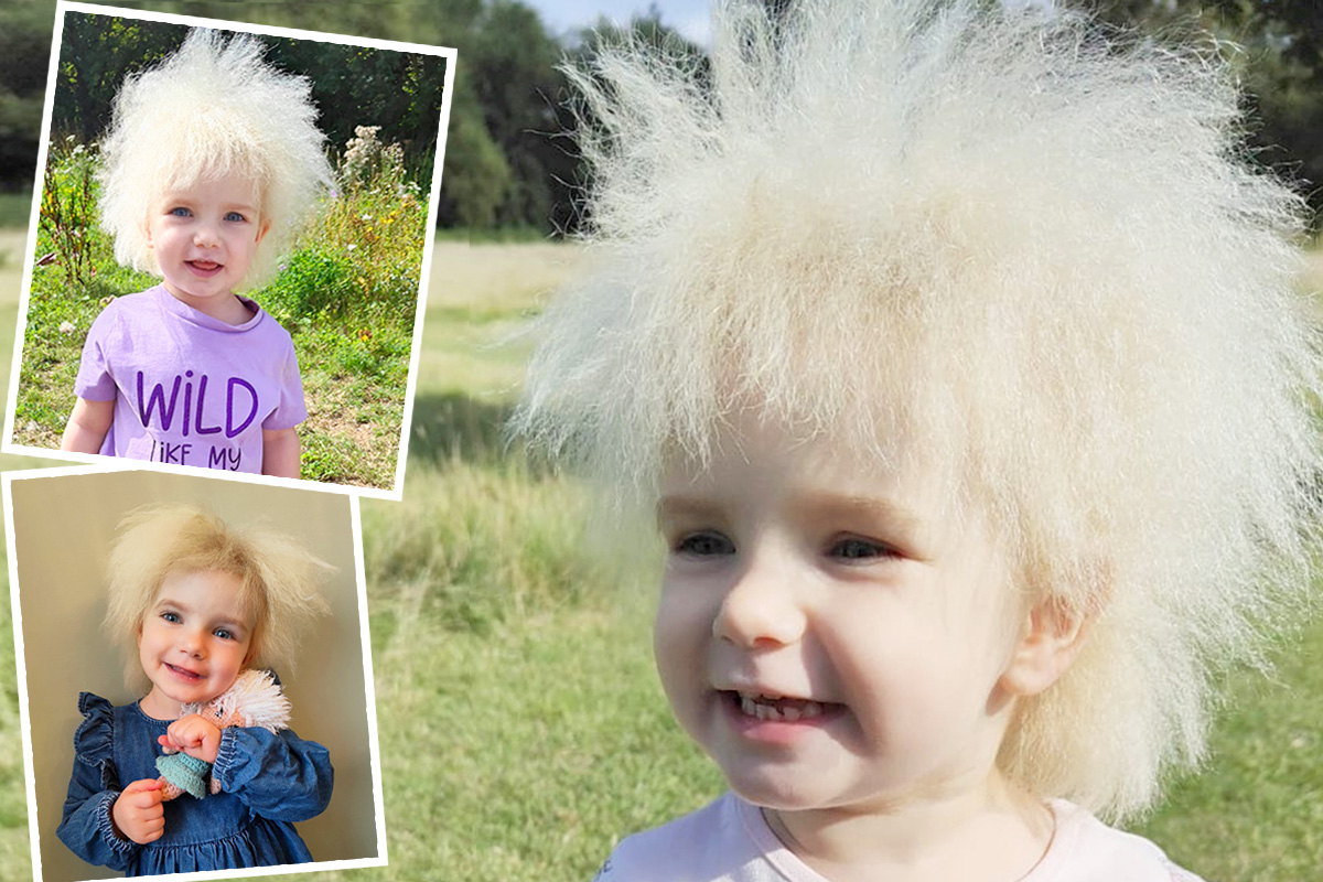 Girl With Frizzy Hair Nicknamed ‘Fluffy’ by Friends—She’s One of Only 100 People in the World With This Syndrome