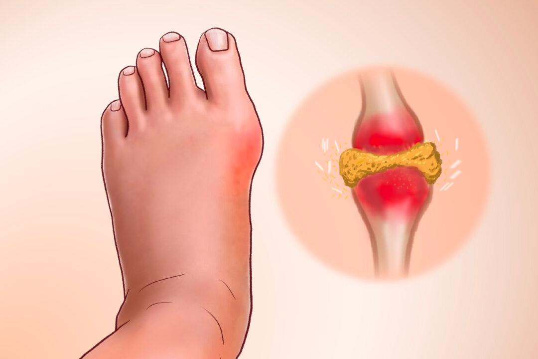 Gout: Crystallized Urate Accumulates in the Joint–6 Natural Approaches to Relieve It