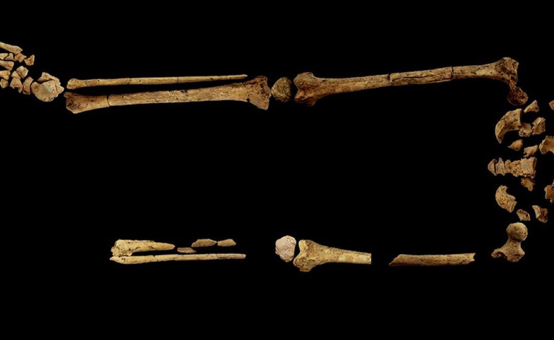 Earliest Known Case of Surgical Amputation Discovered