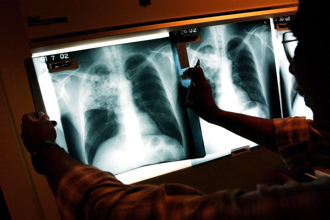 Emergency Declared on Tuberculosis in California City: What to Look For